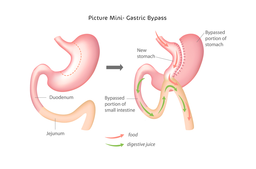 Bariatric Procedures